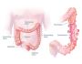Paediatric Malrotation treatment