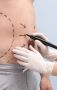 Liposuction surgery in Lahore