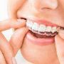 Invisalign Braces Cost in Bangalore - Amaya Dental Clinic