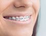 Affordable Dental Braces Near Me