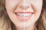 Adult braces before and after
