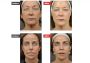 Advanced & Reliable Laser Clinic Burnaby Services