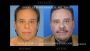 Male Facelift New York – Look Younger & More Defined
