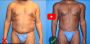 Achieve a Toned Abdomen with Tummy Tuck for Men New York