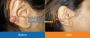 Keloid Treatment in Pune | Keloid Scar Treatment in Pune