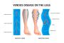 Top 12 Herbs for Varicose Veins in Legs