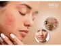 Advanced Acne Treatment in Bangalore - Anew Cosmetic Clinic