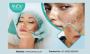 Hyperpigmentations Treatment in Bangalore: Anew Cosmetic Cen