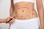 Looking For Full Body Liposuction In Korea?