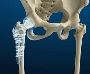 Hip replacement surgery Dubai - Dr Muthana Sartawi