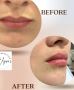 Best Botox Injections in South Yarra