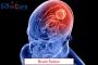 Brain Tumor Treatment in India with EdhaCare