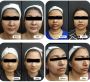 Comprehensive Botox and Filler Training in Bangalore
