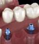 Get a Dental Implant in Kolkata Done by the Best Surgeon