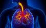 Lungs Allergy Treatment for Better Breathing and Stronger Im