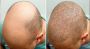 Hair Transplant in Dubai UAE At Glamorous 