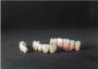 Dental Crowns Willoughby