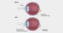Best Lasik hospital in Bapunagar, Ahmedabad 