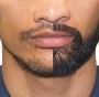 Full Beard Transplant in Gurgaon Enhance Your Look Now with