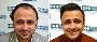 ​Instant Hair Transformation in Kochi – Book Your Patch Now