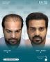 Trusted FUE Hair Transplant Clinic in Delhi – Book Now!