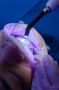 Clear Aligners for Teeth