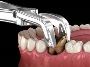 Tooth Extraction: Aftercare Tips for Kids