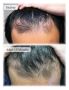 Effective Hair Loss Treatment in Sydney 