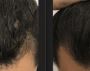 Unlock Confidence with the Best Hair Regrowth Treatment
