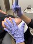 microneedling kansas city