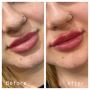 Acne scar treatment | Medical skin treatments Melbourne
