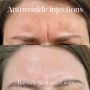 Smooth Out Wrinkles with Expert Anti-Wrinkle Injections