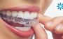 Teeth Whitening Service In Huntington Beach