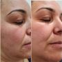 SQT Bio Microneedling Reviews