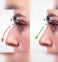 Rhinoplasty Surgeon in Ahmedabad | How Rhinoplasty Works