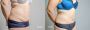 Body Contouring Surgery Clinic in Ahmedabad