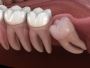 Safe and Effective Wisdom Tooth Extraction in Chatswood
