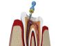 Best Root Canal Treatment in Kolkata