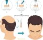 Best hospitals for hair transplant in India