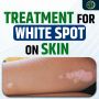 Vitiligo Treatment Naturally: Natural Remedies