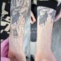 Cheap Laser Tattoo Removal in London – Safe and Effective