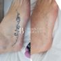 Fast and Affordable Laser Tattoo Removal in Birmingham