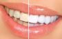 Professional Teeth Whitening Services in Murwillumbah