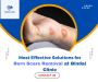 Advanced Burning Scar Treatment at Bindal Clinic 