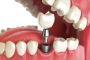 LASER DENTAL TREATMENT