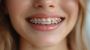 Affordable Braces Singapore – Achieve Your Perfect Smile