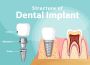 Affordable Dental Implants – Restore Your Confident Smile