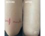 Say Goodbye to Unwanted Ink with Bourne Beauty Tattoo Remova