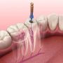 Endodontic Treatment in Glendale, Arizona