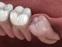Wisdom Teeth Removal in Lake Havasu City, Arizona